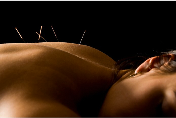 Townsville Dry Needling